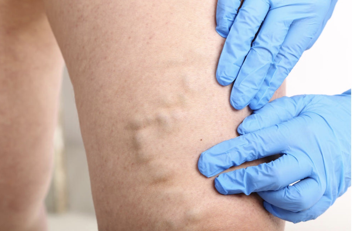 Лікування варикозу: як зберегти здоров’я вен і легкість у ногах